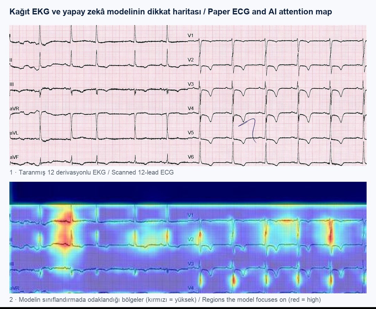 Paper ECG and the AI model's attention heat map on the ECG